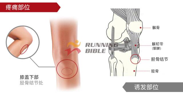 9种春训跑步膝伤，你该这样预防