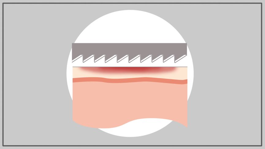 21图｜全面预防夏季跑步损伤！