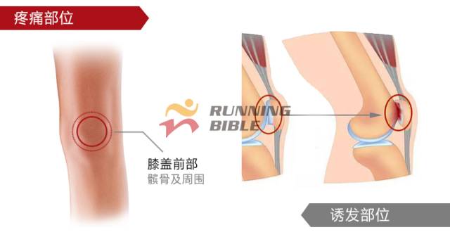 9种春训跑步膝伤，你该这样预防