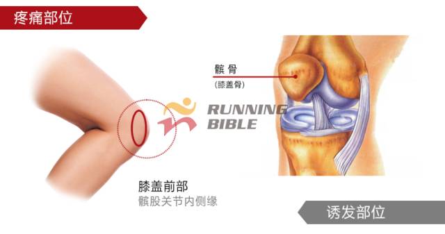 9种春训跑步膝伤，你该这样预防