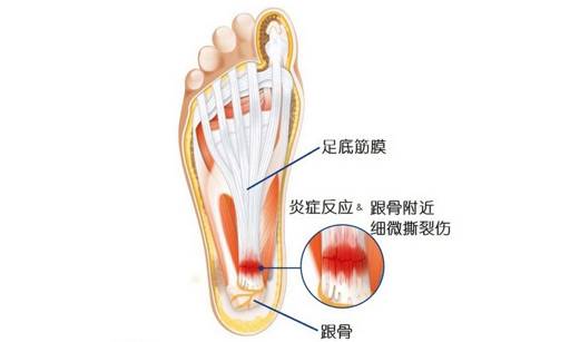 福利｜除了足底筋膜炎，我们更应该了解筋膜的这些好处！