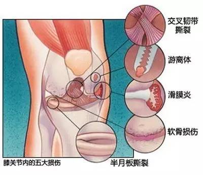 盘点五种常见膝伤！教你跑步不伤膝