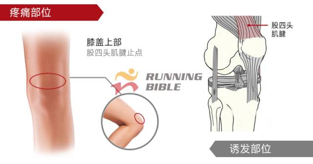 9种春训跑步膝伤，你该这样预防