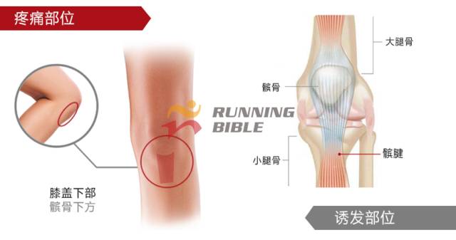 9种春训跑步膝伤，你该这样预防