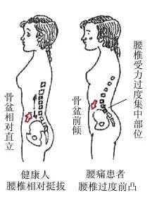 腰粗屁股大?你只是骨盆前倾了! 腰粗屁股大?你只是骨盆前倾了!