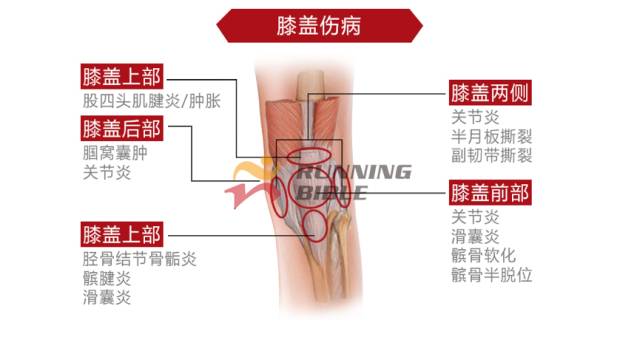 9种春训跑步膝伤，你该这样预防