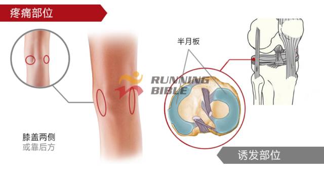 9种春训跑步膝伤，你该这样预防