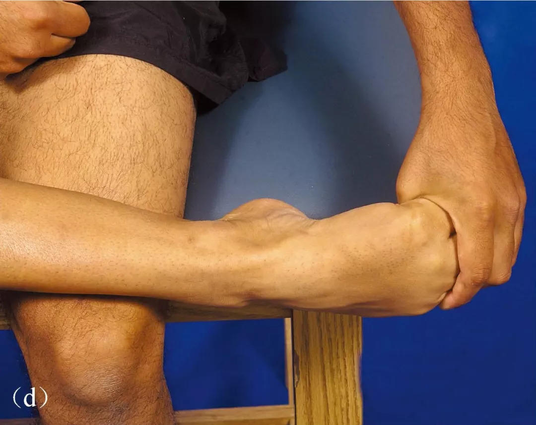 远离足底筋膜炎，来试试这些办法吧