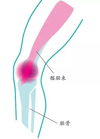 1个小道具，帮你远离跑步损伤